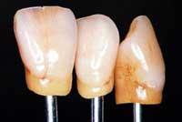 ceramic crowns