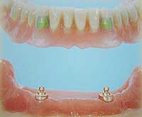 dental implant bridge