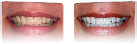 teeth whitening photos