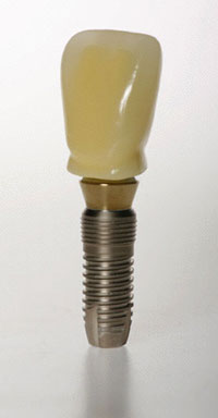 dental implant